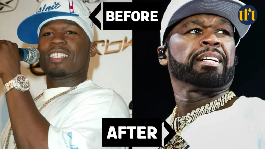 50-cent-veneers-before-and-after-results