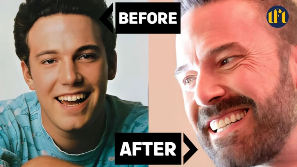 ben-affleck-veneers-before-and-after-results