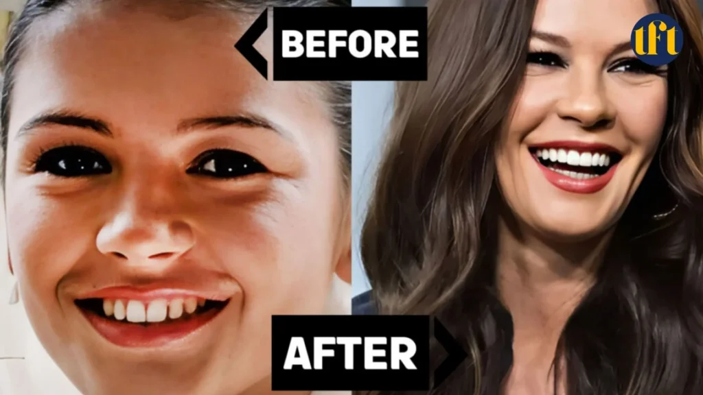 catherine-zeta-jones-veneers-before-and-after-results