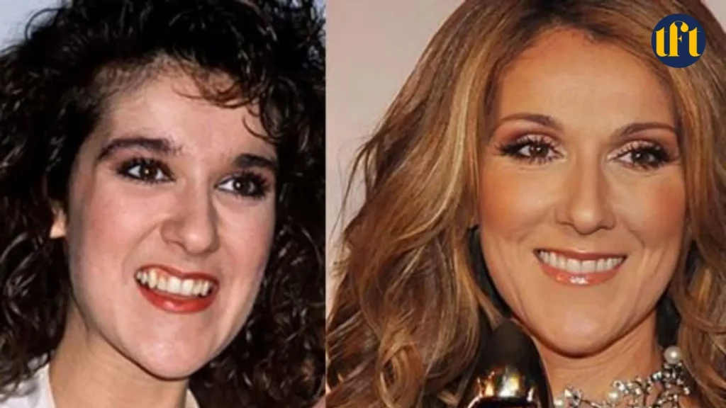 celine-dion-veneers-before-and-after-results