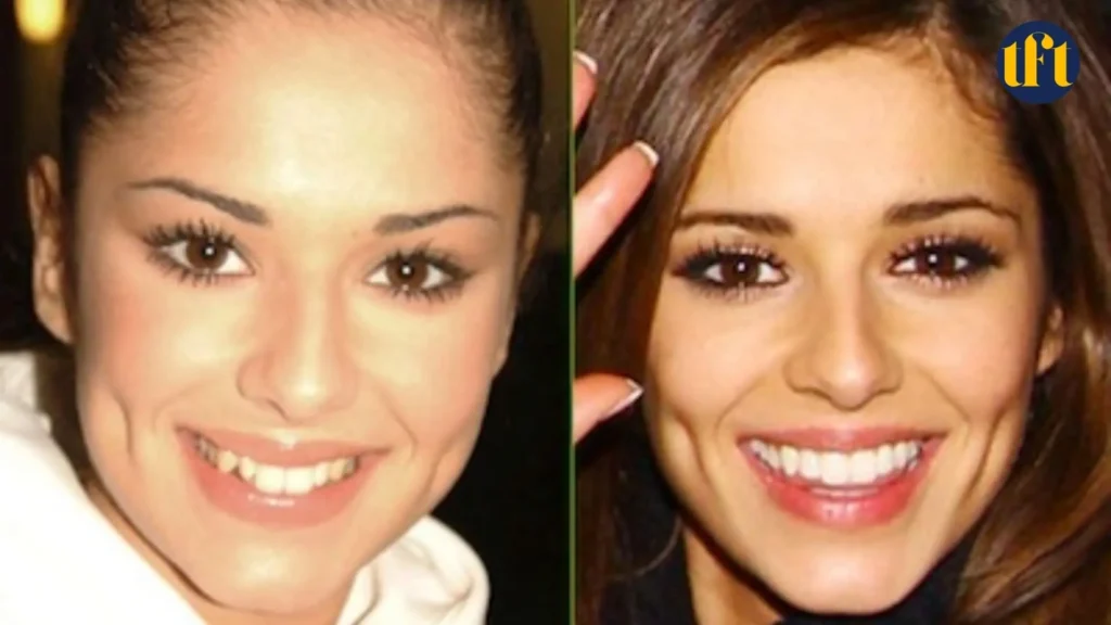 cheryl-cole-veneers-before-and-after-results
