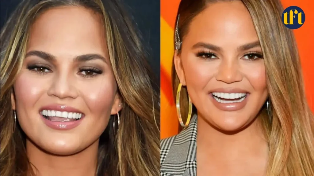 chrissy-teigen-veneers-before-and-after-results