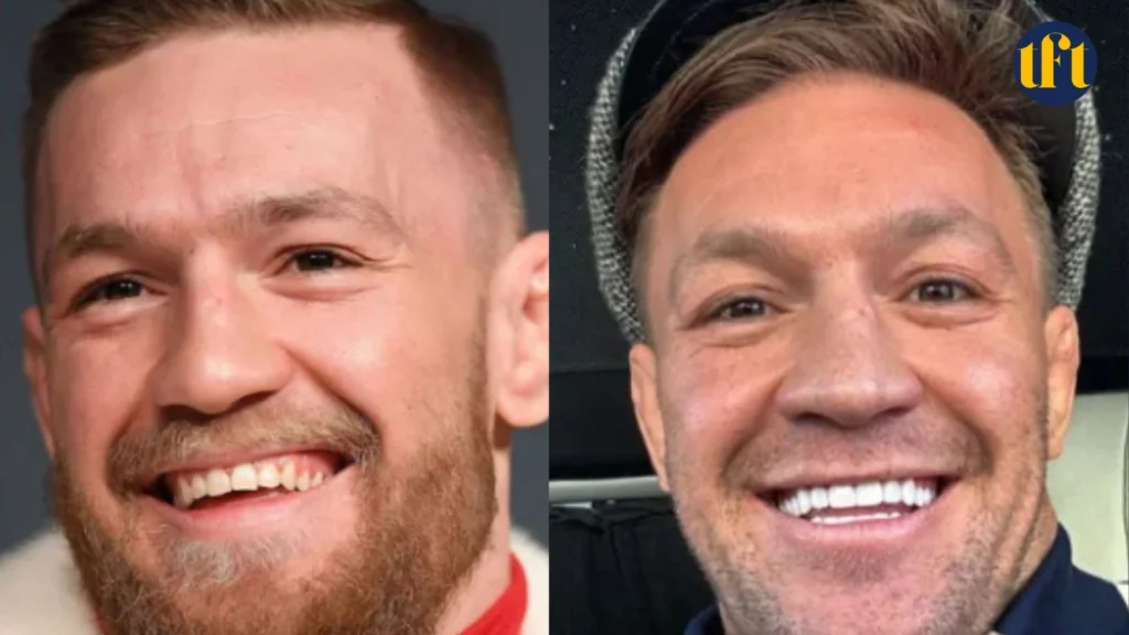 conor mcgregor veneers before and after results