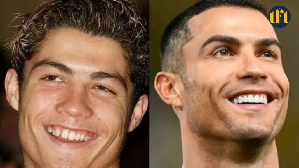 cristiano-ronaldo-veneers-before-and-after-results