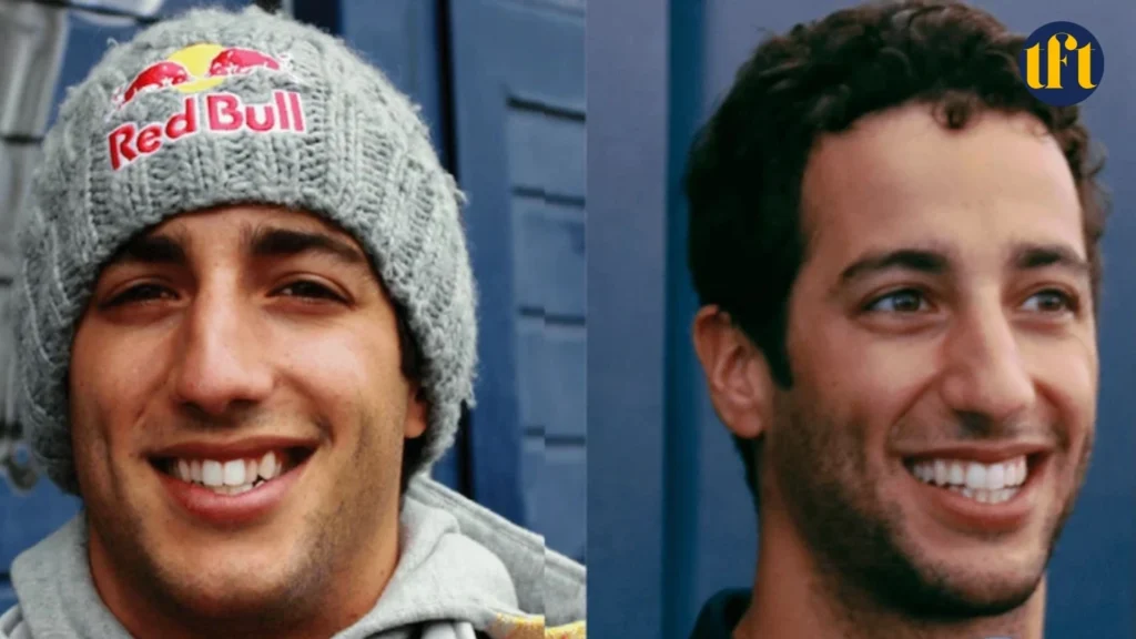 daniel-ricciardo-veneers-before-and-after-results