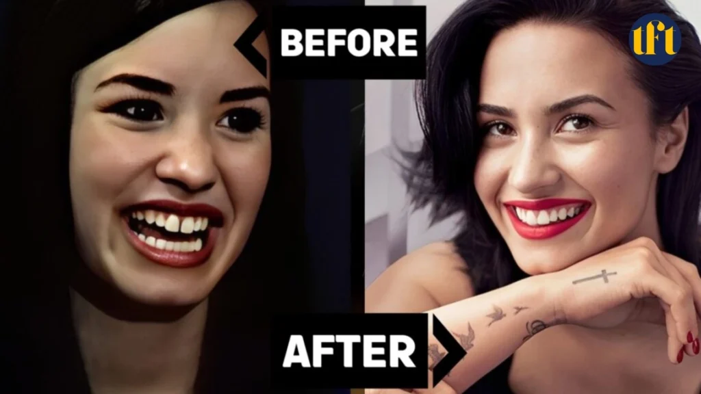 demi-lovato-veneers-before-and-after-results