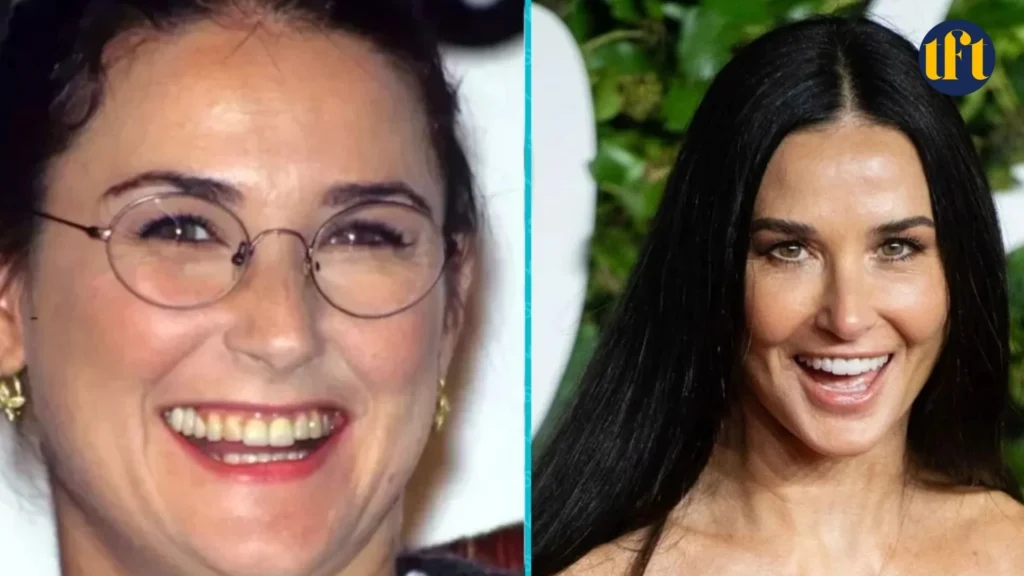 demi-moore-veneers-before-and-after-results