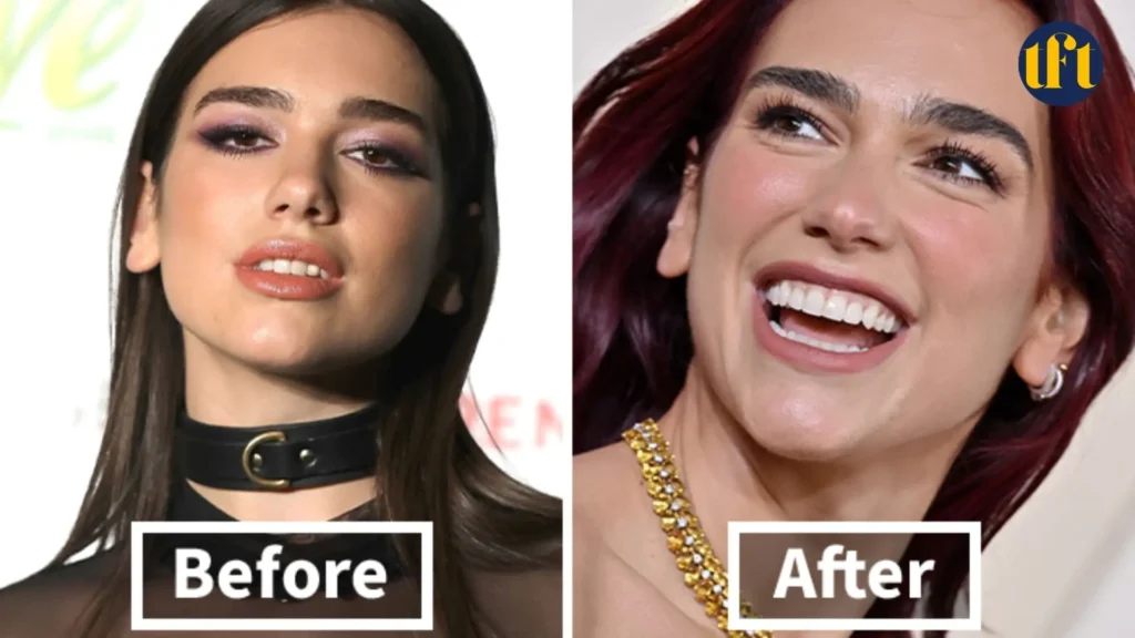 Dua Lipa Veneers
