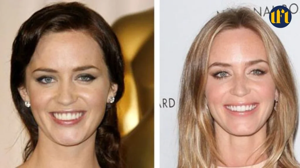emily-blunt-veneers-before-and-after-results