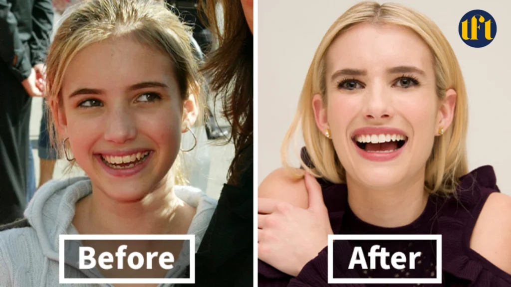 emma-roberts-veneers-before-and-after-results