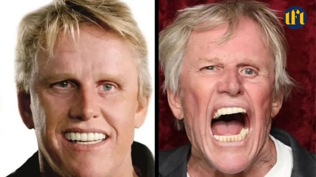 gary-busey-veneers-before-and-after-results