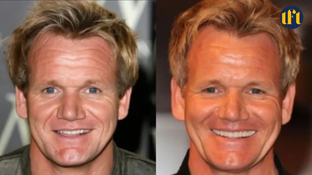 gordon-ramsay-veneers-before-and-after-results