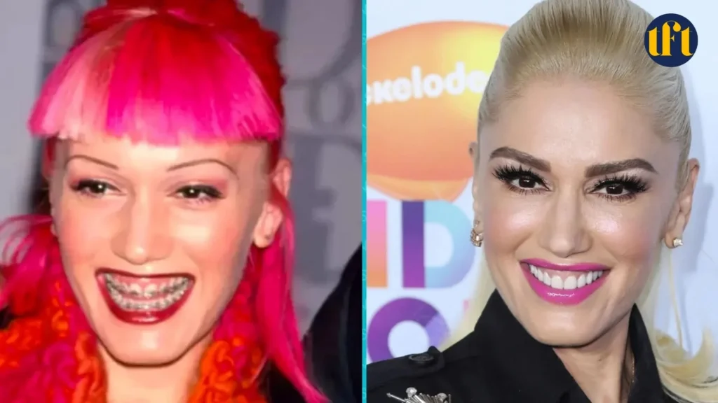 gwen-stefani-veneers-before-and-after-results