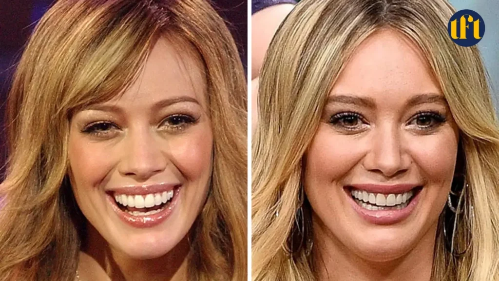hilary-duff-veneers-before-and-after-results