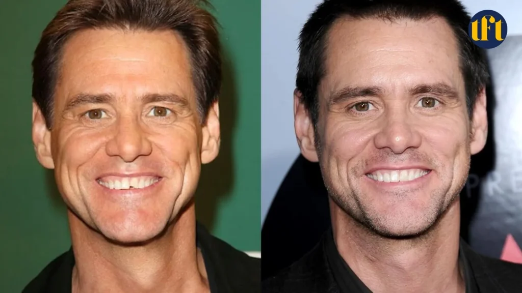 jim-carrey-veneers-before-and-after-results