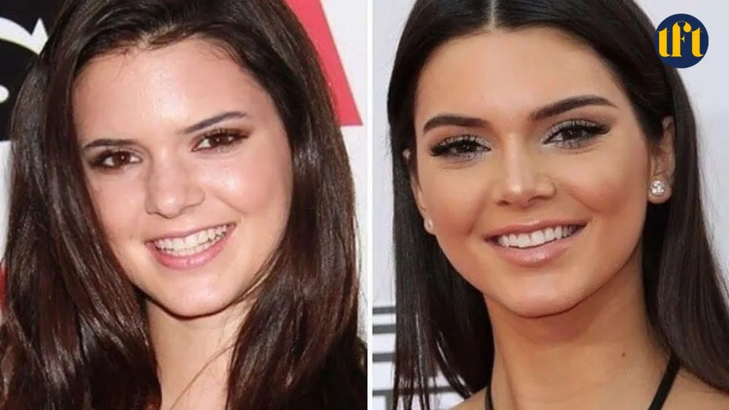 Kendall Jenner Veneers