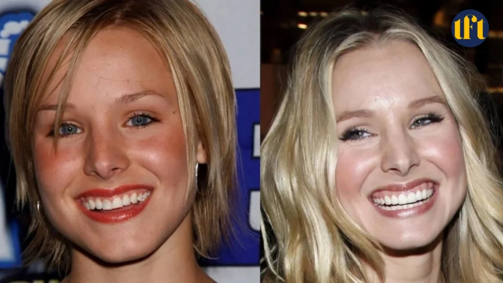 kristen-bell-veneers-before-and-after-results