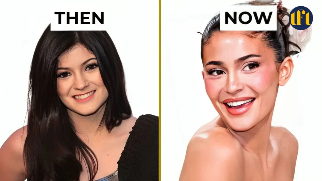 kylie-jenner-veneers-before-and-after-results