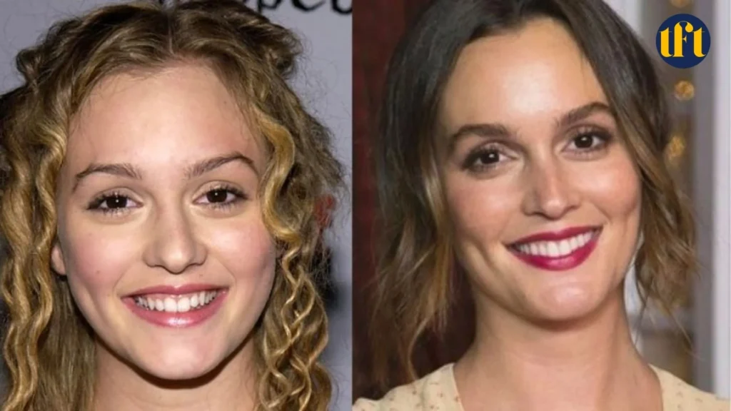 leighton-meester-veneers-before-and-after-results