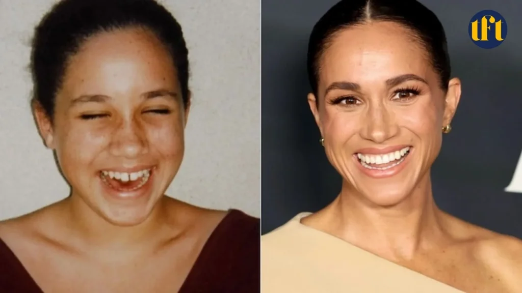 meghan-markle-veneers-before-and-after-results