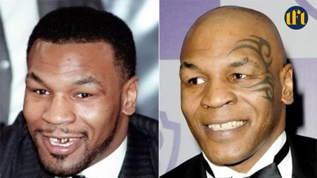 mike-tyson-veneers-before-and-after-results