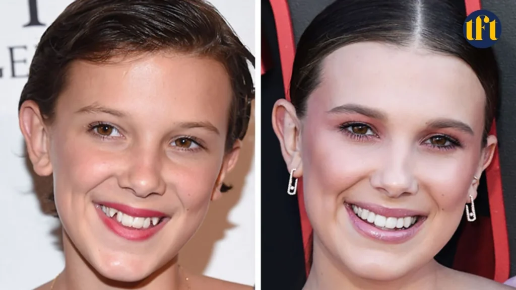 millie-bobby-brown-veneers-before-and-after-results