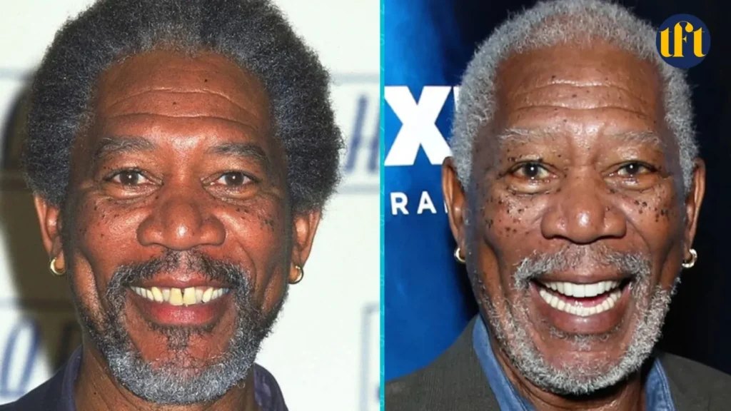 morgan-freeman-veneers-before-and-after-results