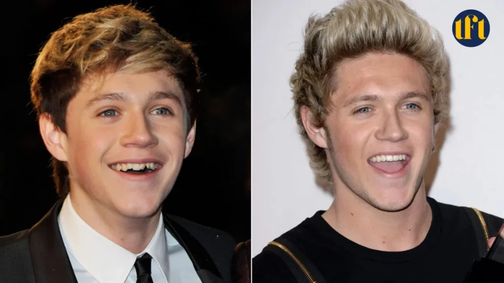 niall-horan-veneers-before-and-after-results