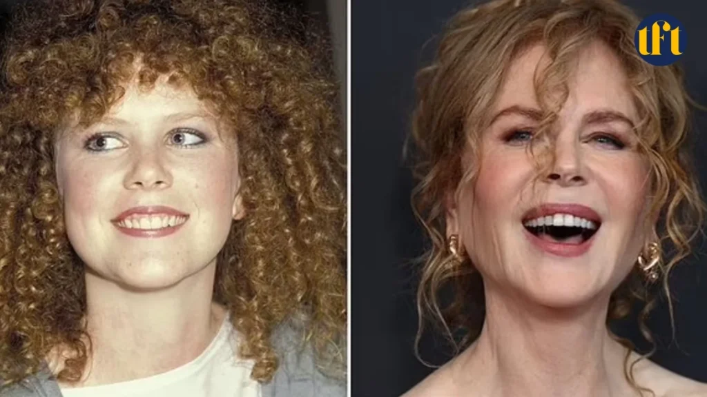 nicole-kidman-veneers-before-and-after-results