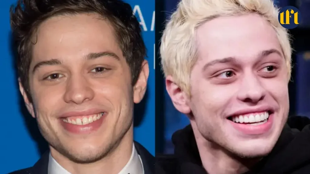 pete-davidson-veneers-before-and-after-results