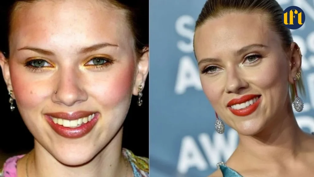 scarlett-johansson-veneers-before-and-after-results