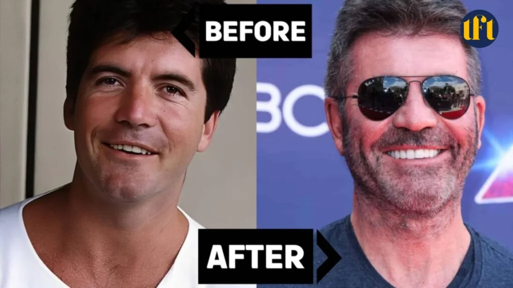 simon-cowell-veneers-before-and-after-results