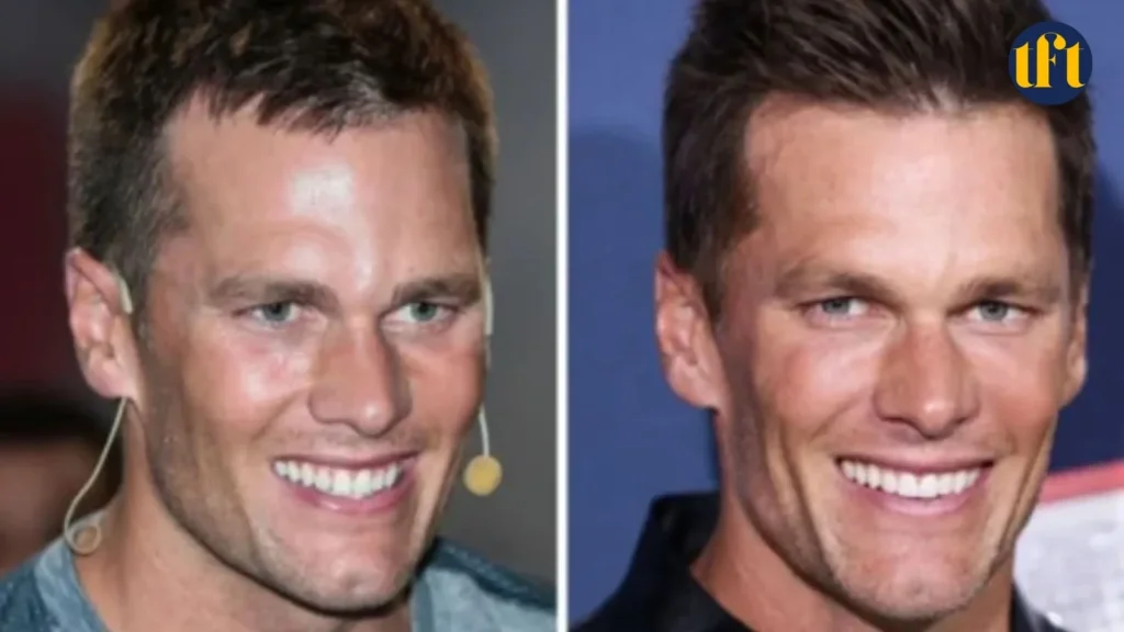 tom-brady-veneers-before-and-after-results