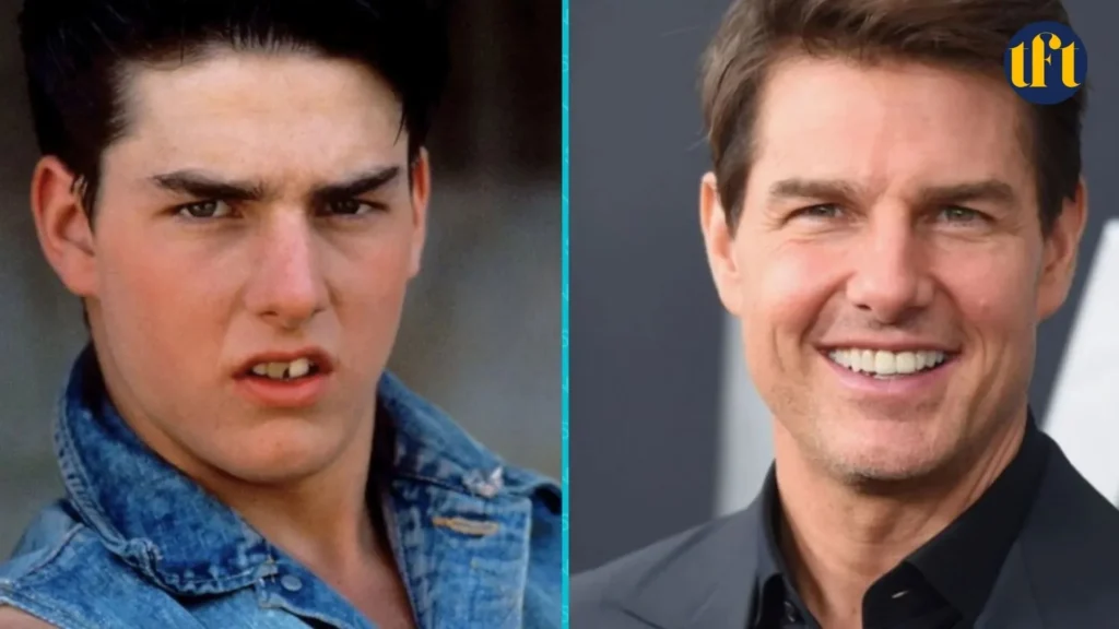 tom-cruise-veneers-before-and-after-results