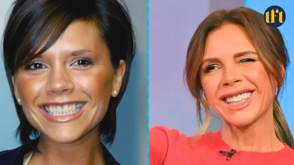 victoria-beckham-veneers-before-and-after-results