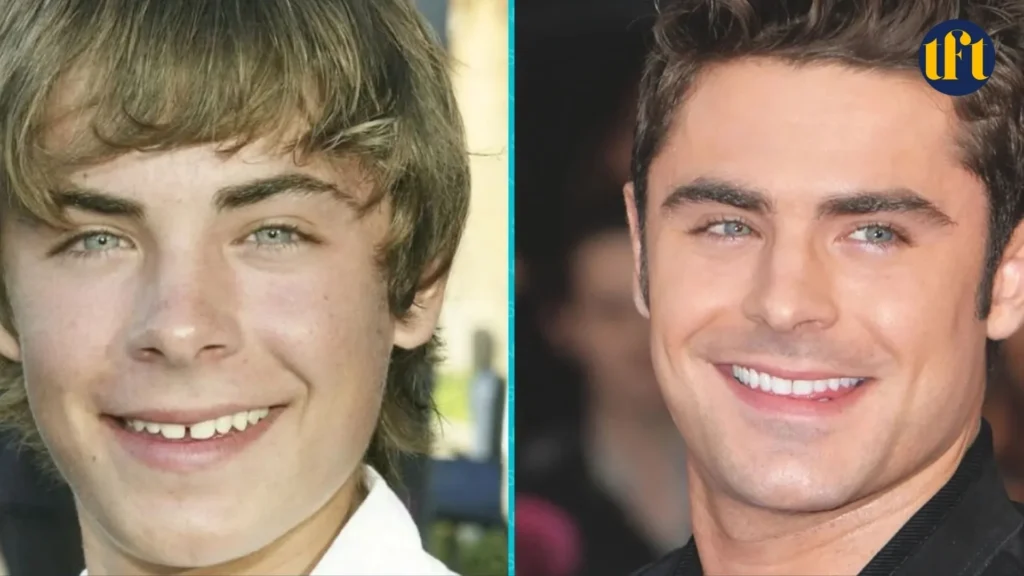 zac-efron-veneers-before-and-after-results